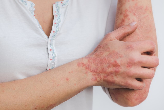 Quelles sont les causes du psoriasis ?